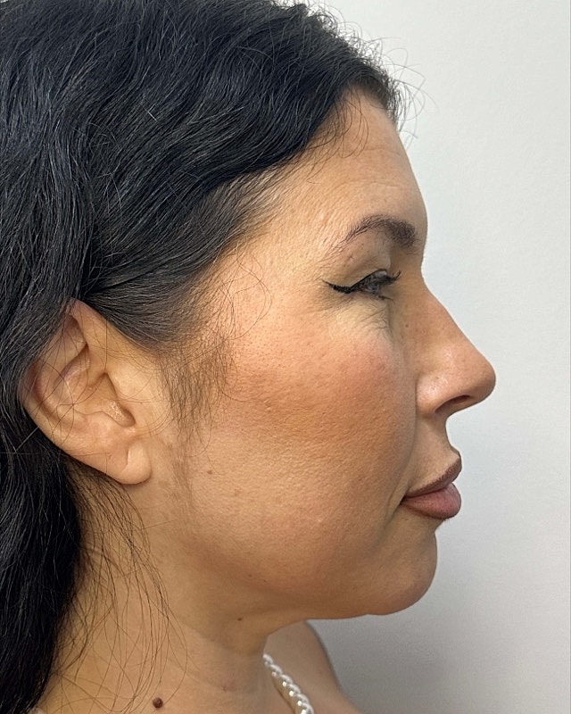 Juvederm Before & After
