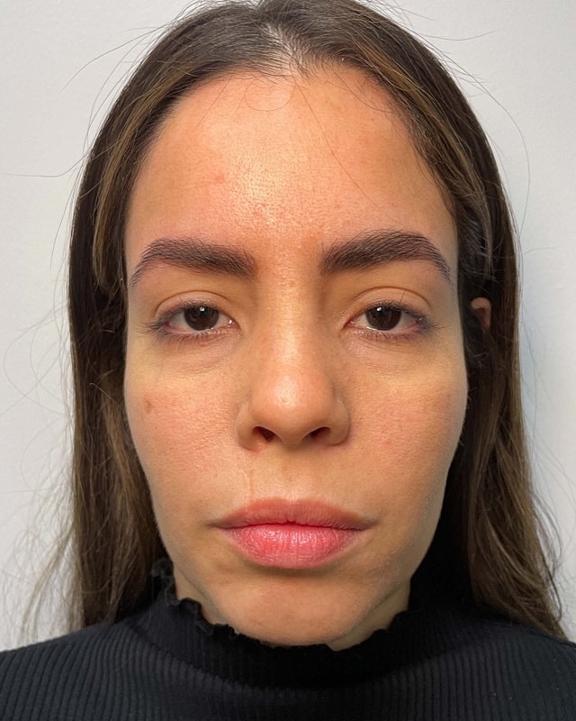 Juvederm Before & After