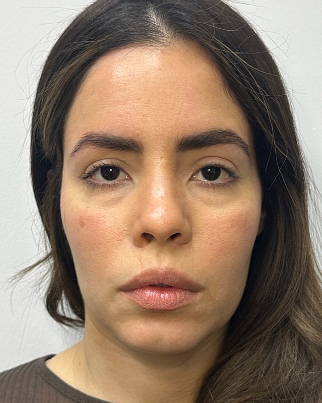 Juvederm Before & After