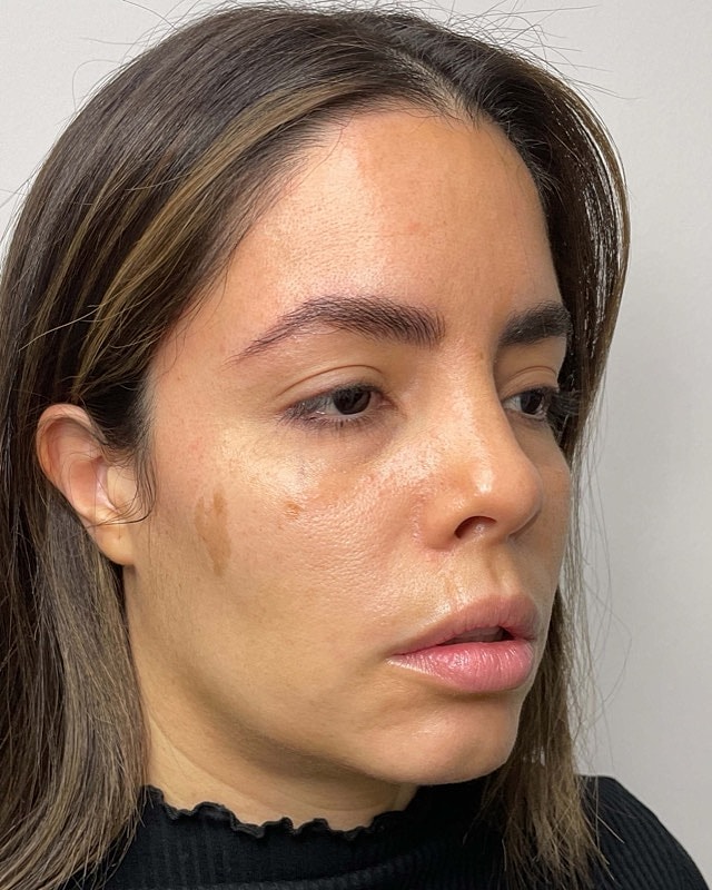Juvederm Before & After