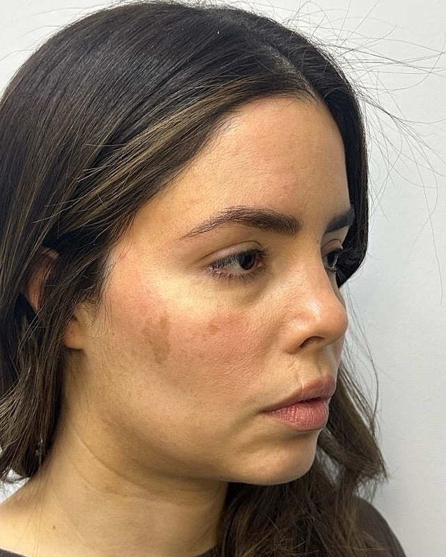 Juvederm Before & After