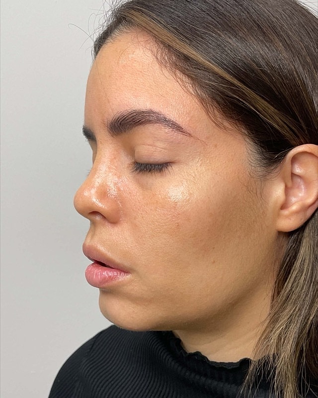 Juvederm Before & After