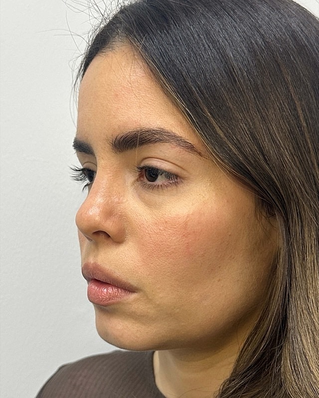 Juvederm Before & After