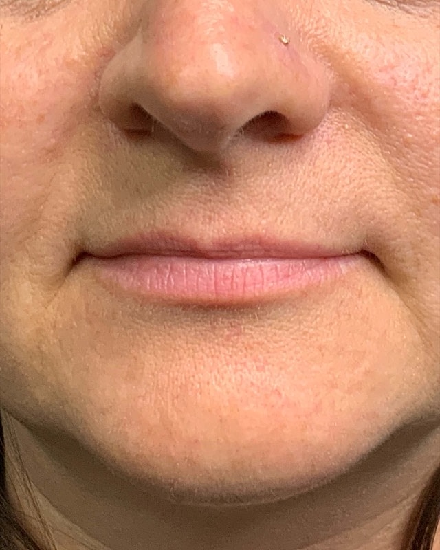 Juvederm Before & After