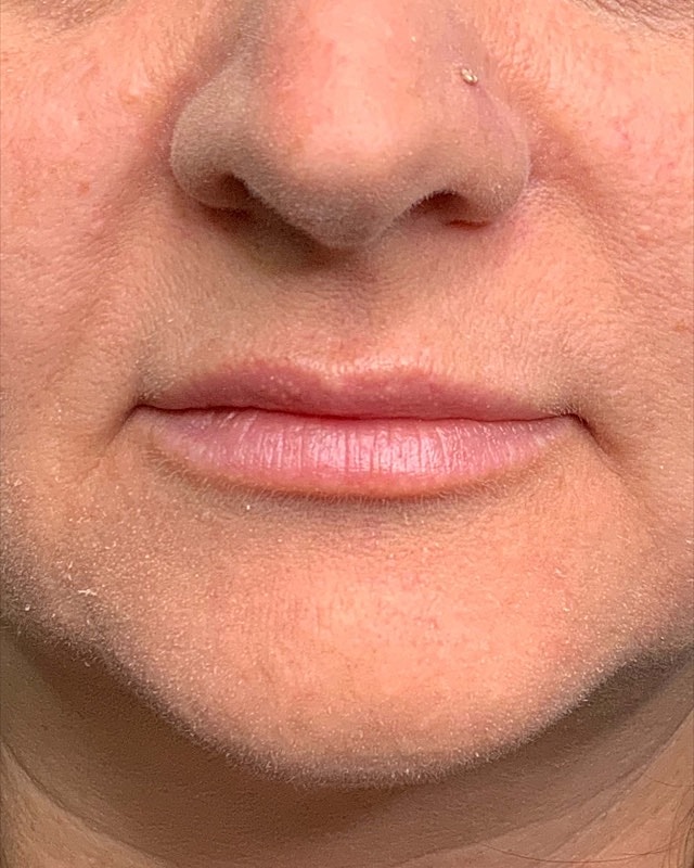 Juvederm Before & After