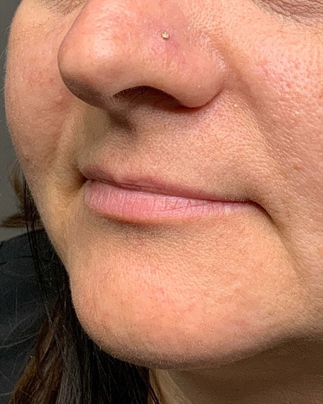 Juvederm Before & After