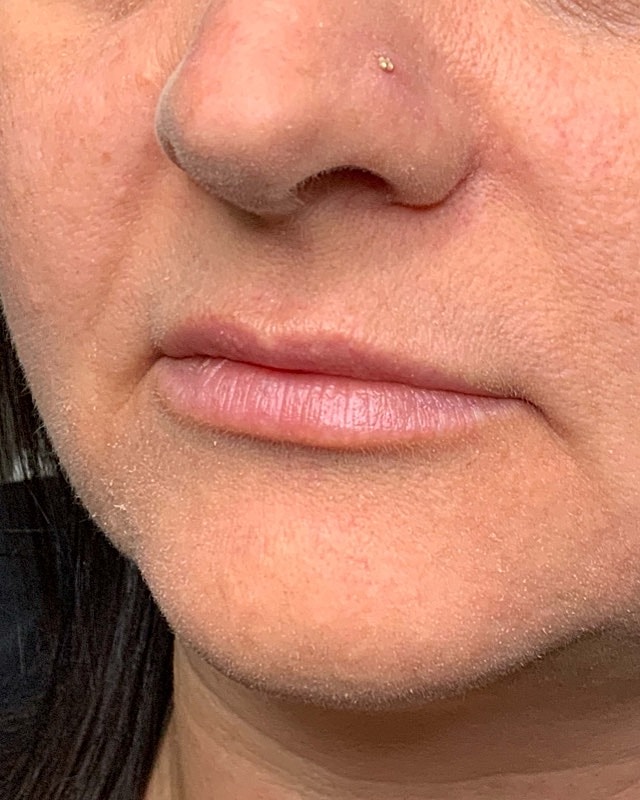 Juvederm Before & After