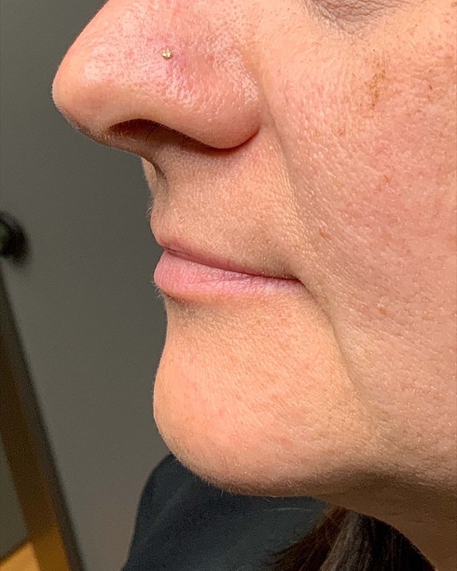 Juvederm Before & After