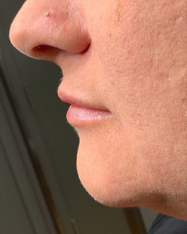 Juvederm Before & After