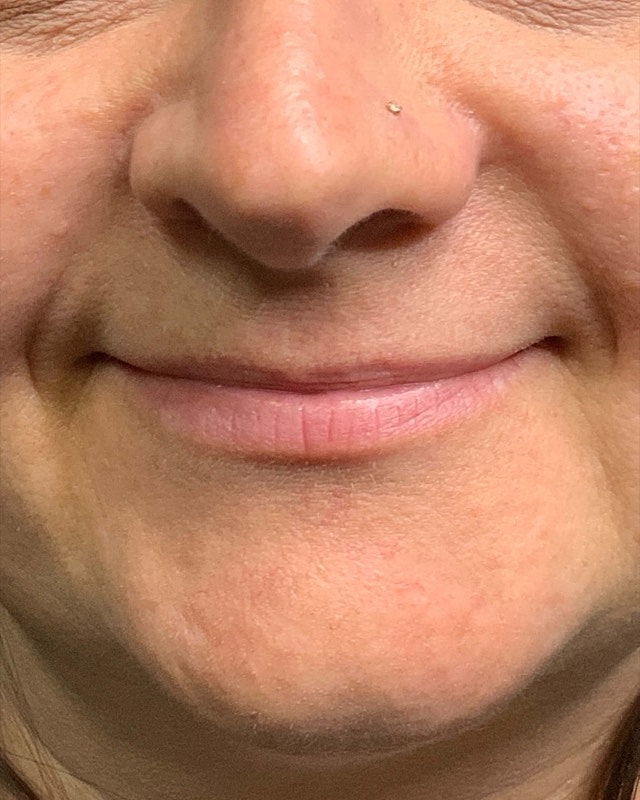 Juvederm Before & After