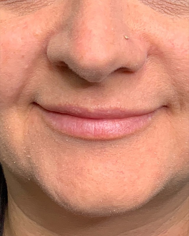 Juvederm Before & After