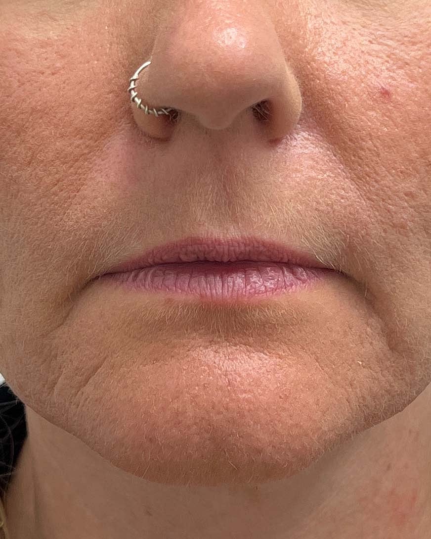Juvederm Before & After