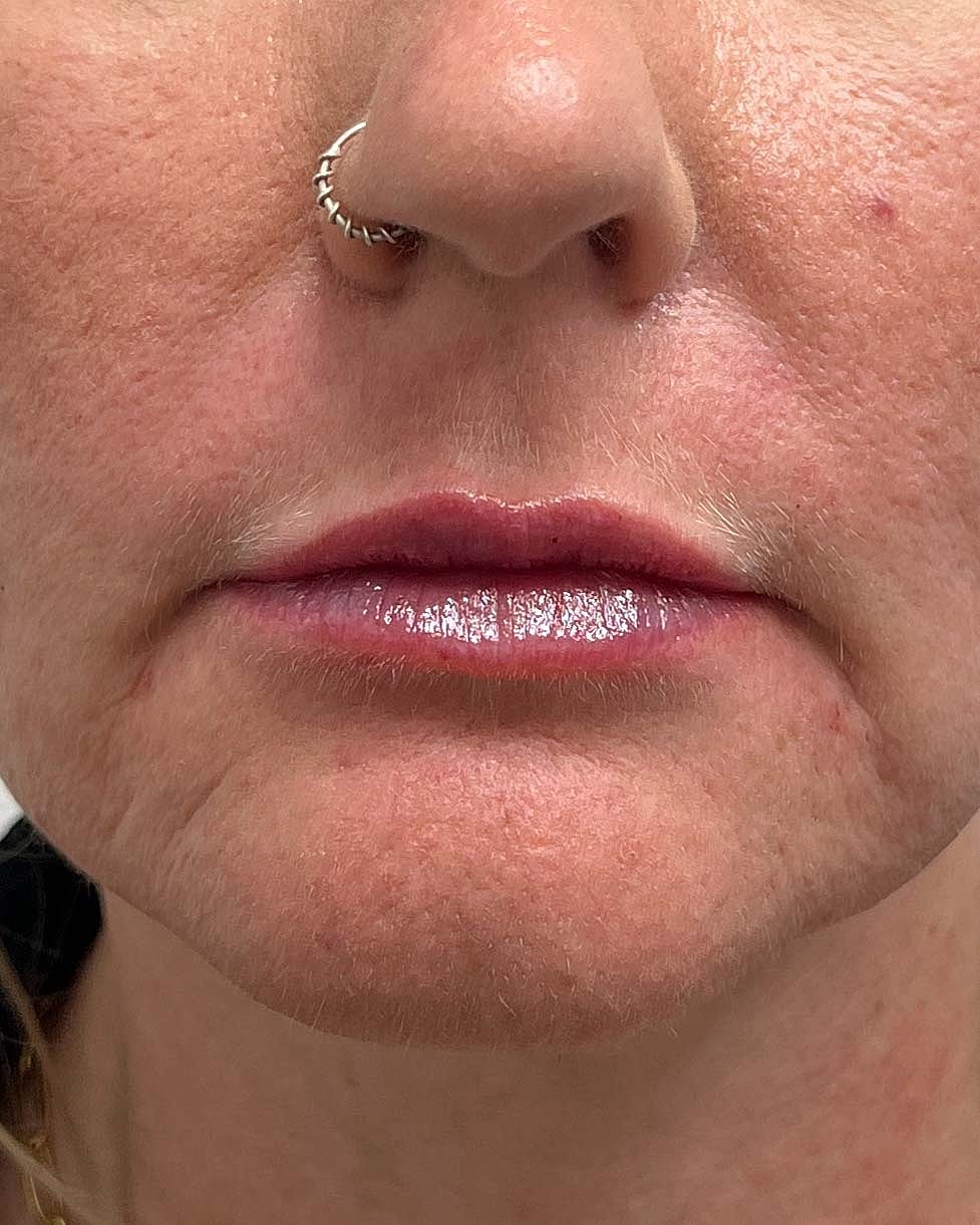 Juvederm Before & After
