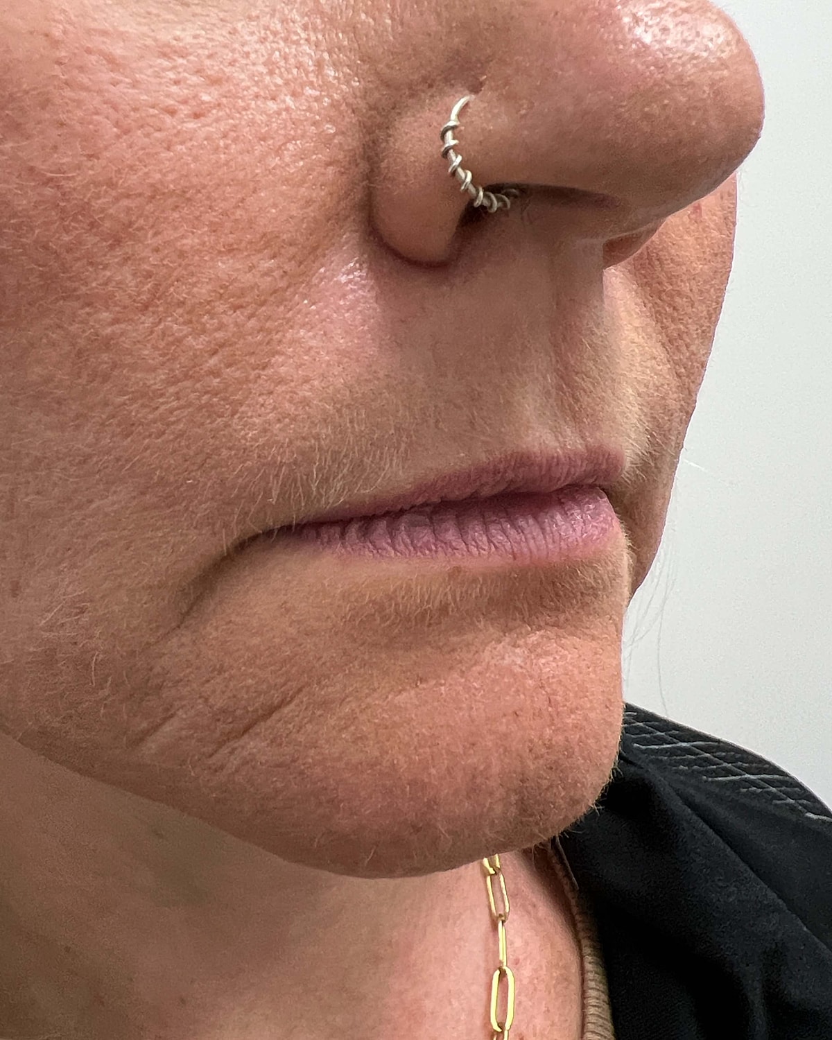 Juvederm Before & After