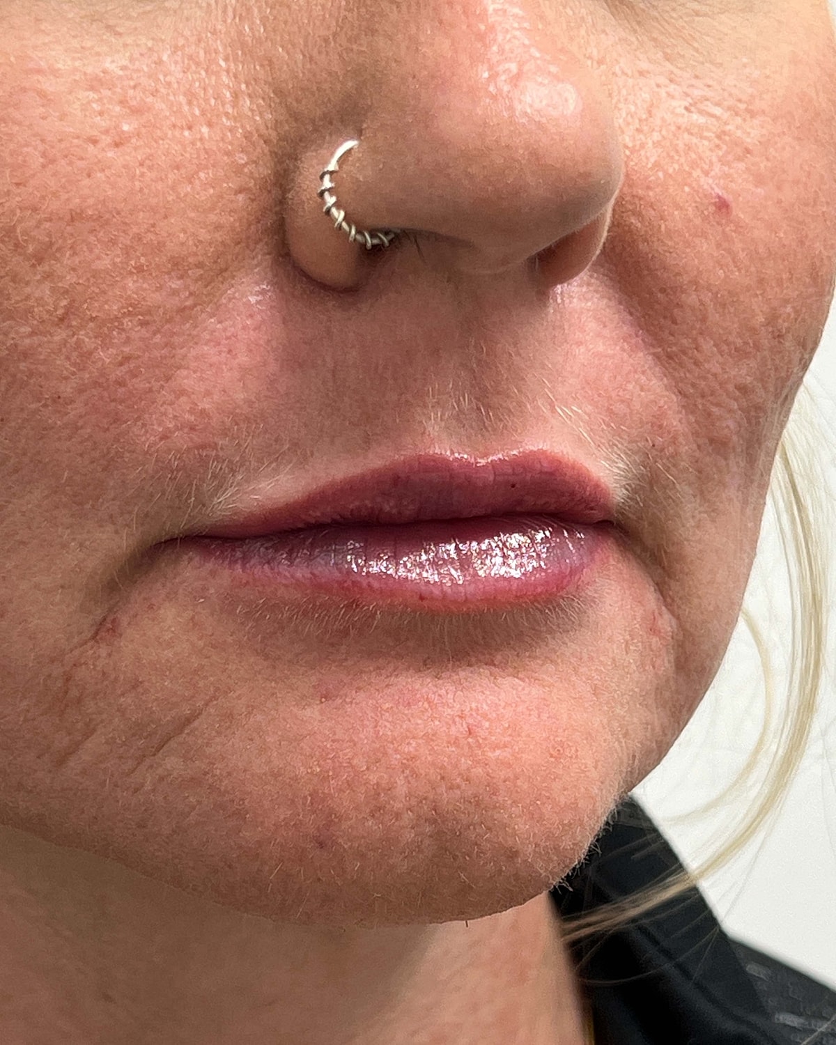 Juvederm Before & After
