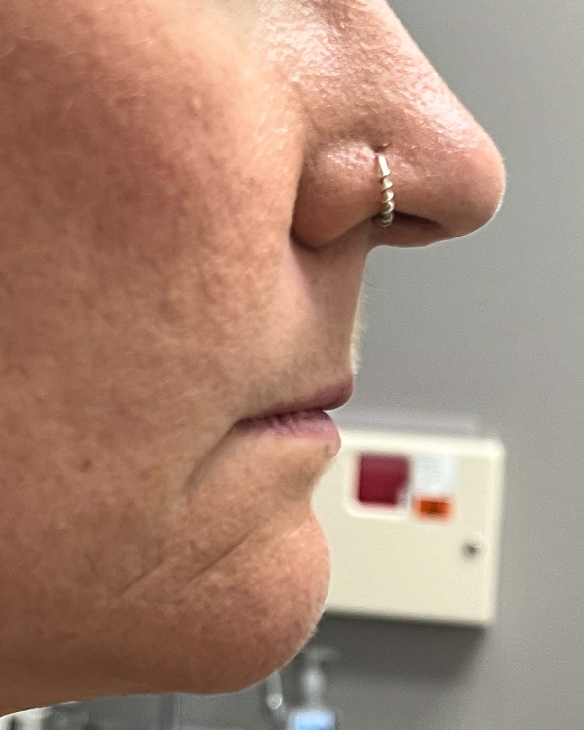 Juvederm Before & After