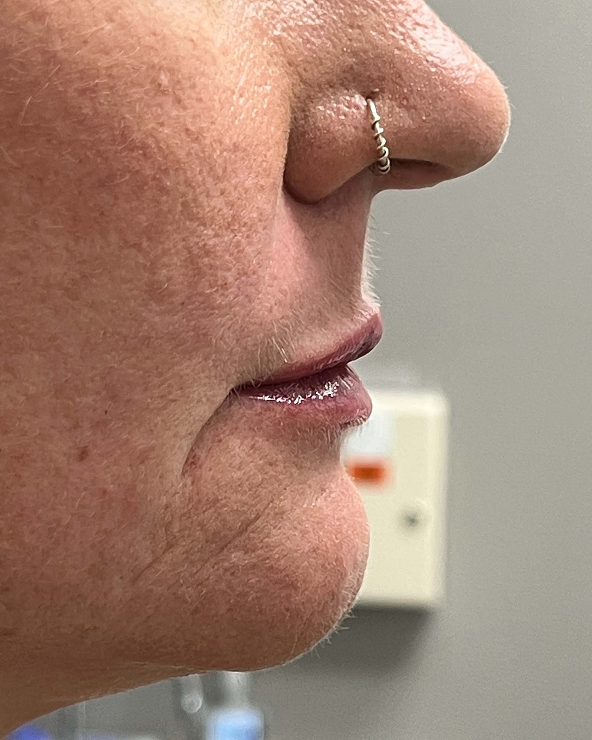 Juvederm Before & After