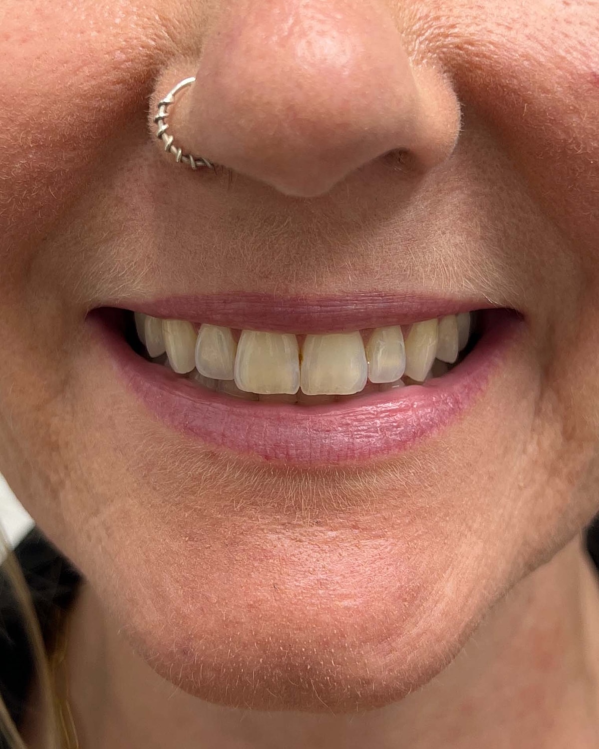 Juvederm Before & After