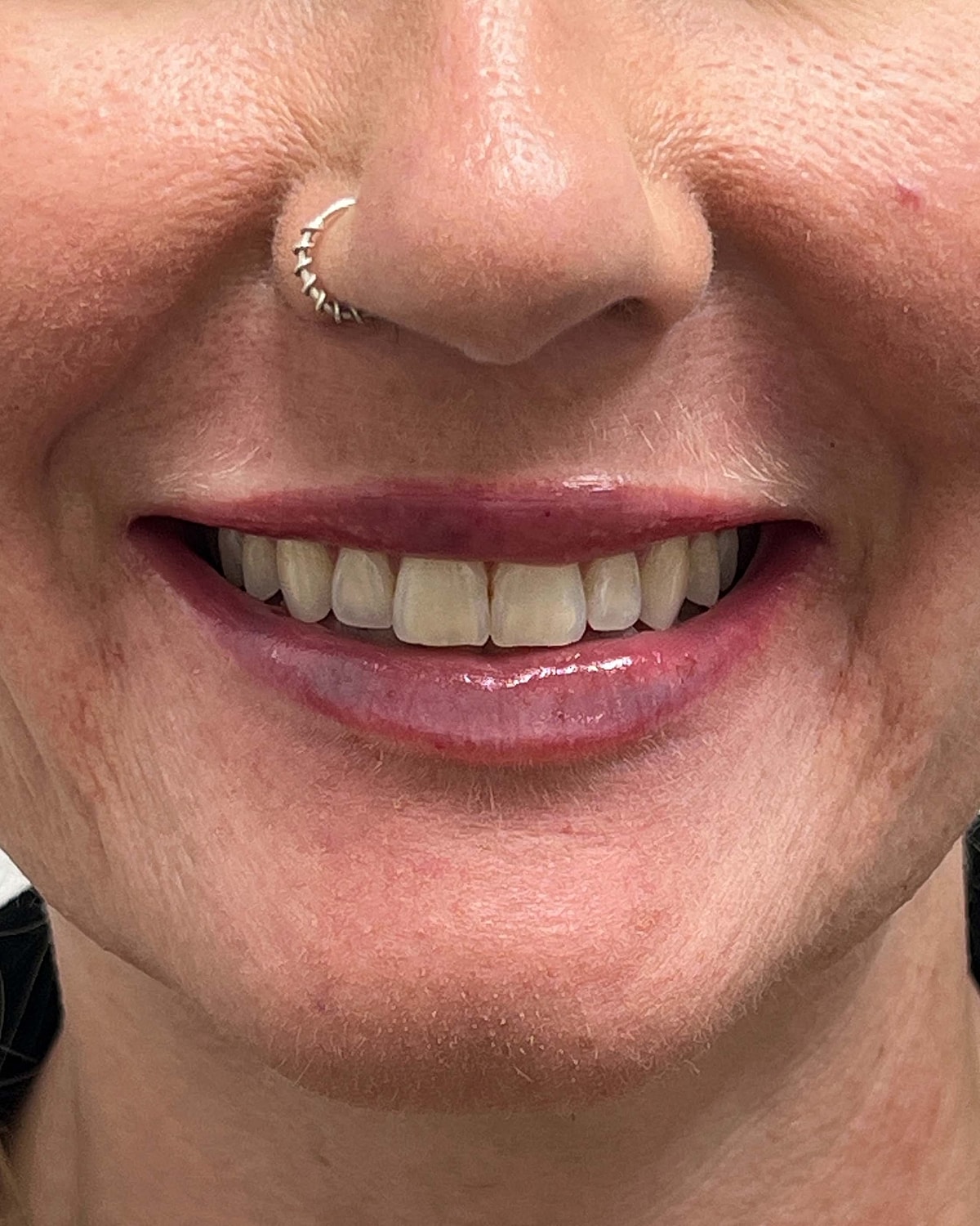 Juvederm Before & After