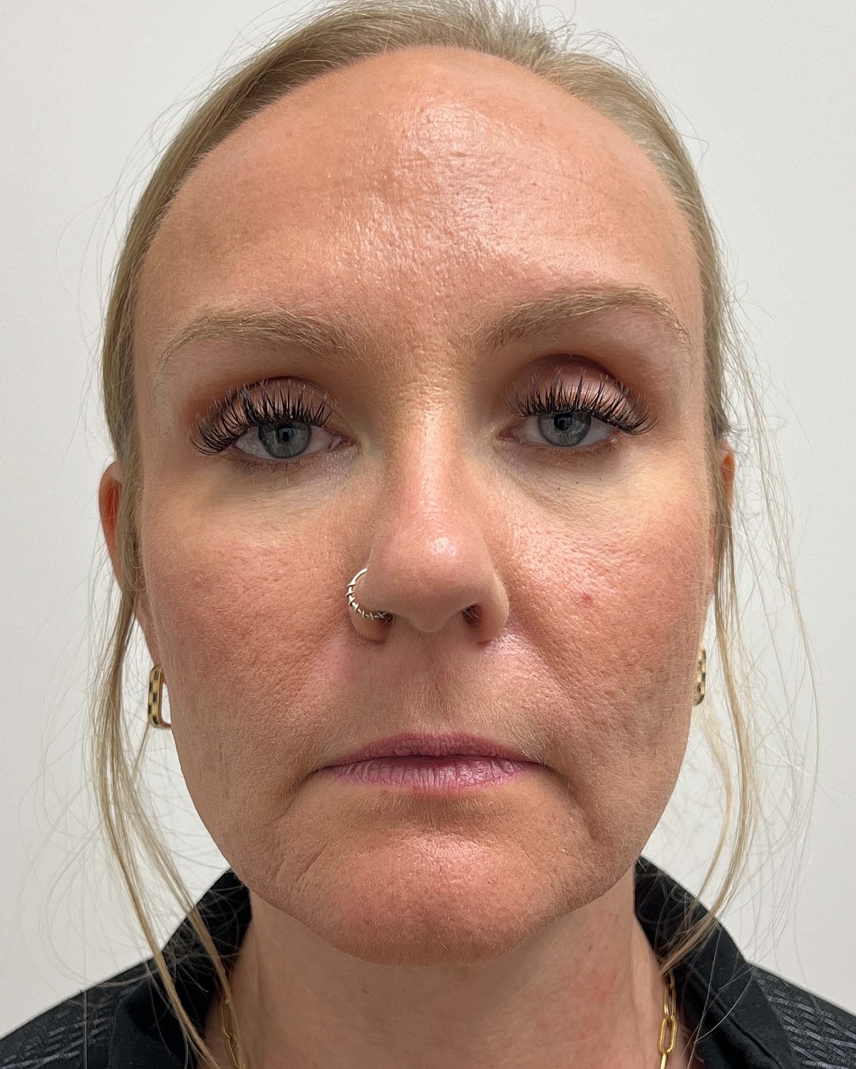 Juvederm Before & After
