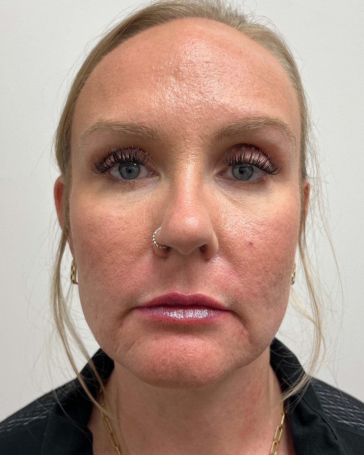 Juvederm Before & After