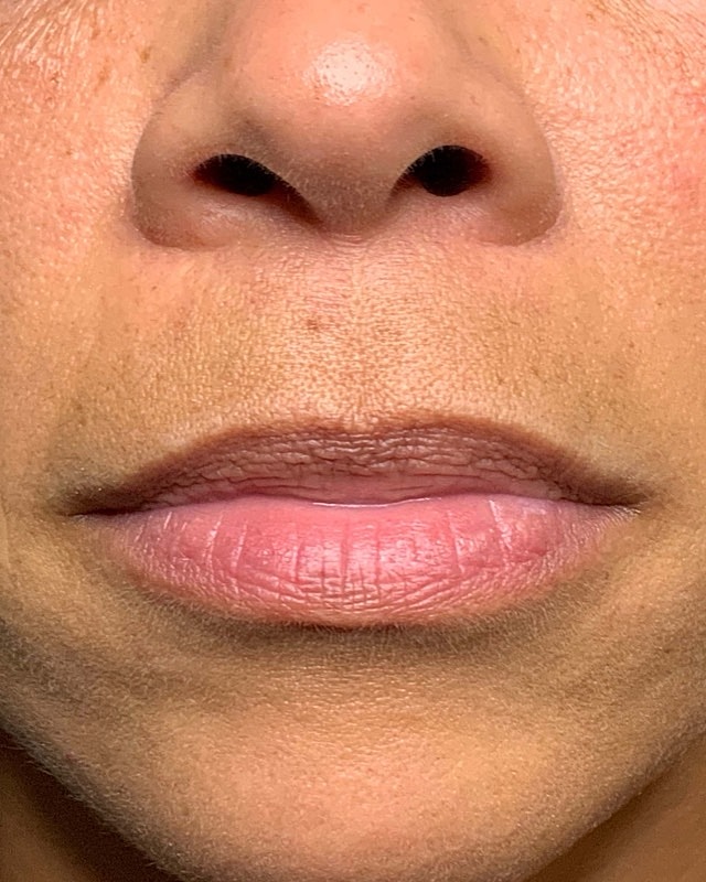 Juvederm Before & After