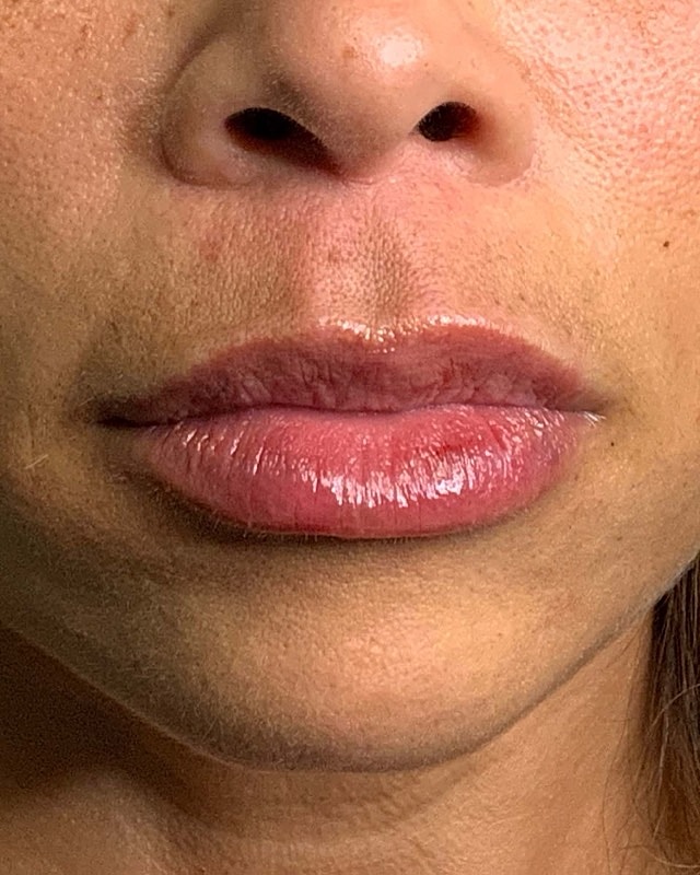 Juvederm Before & After