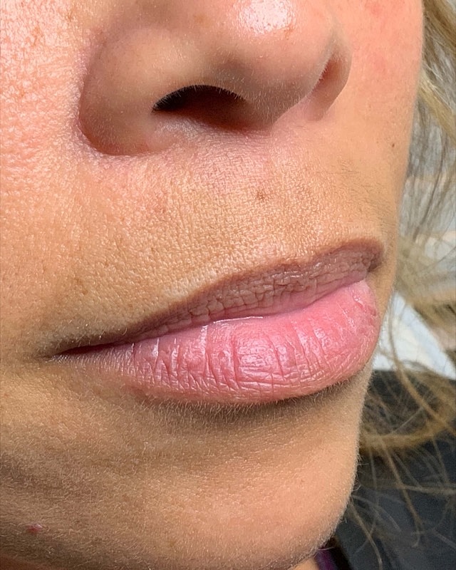 Juvederm Before & After
