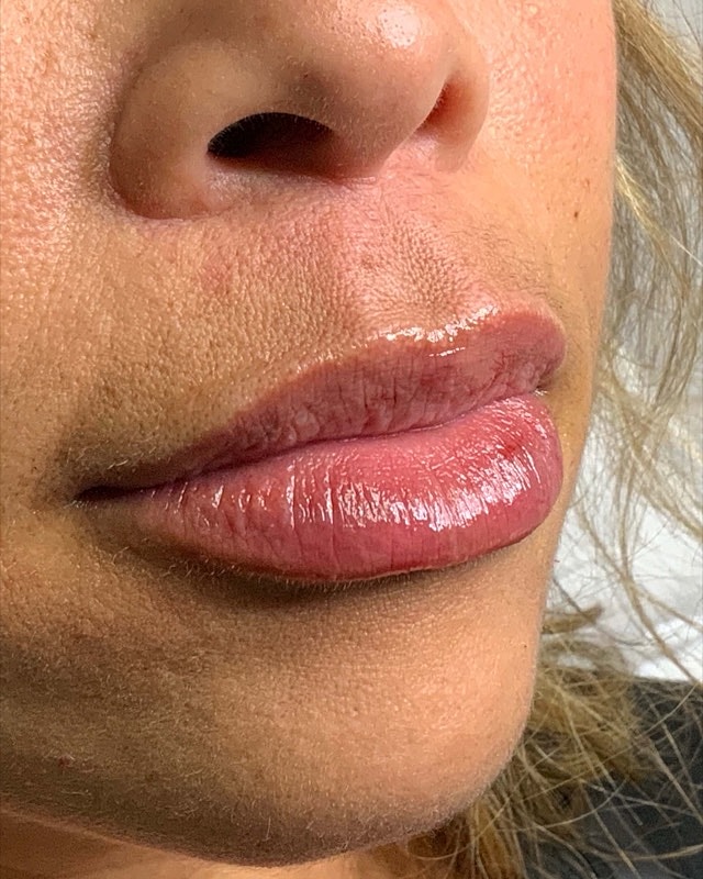 Juvederm Before & After