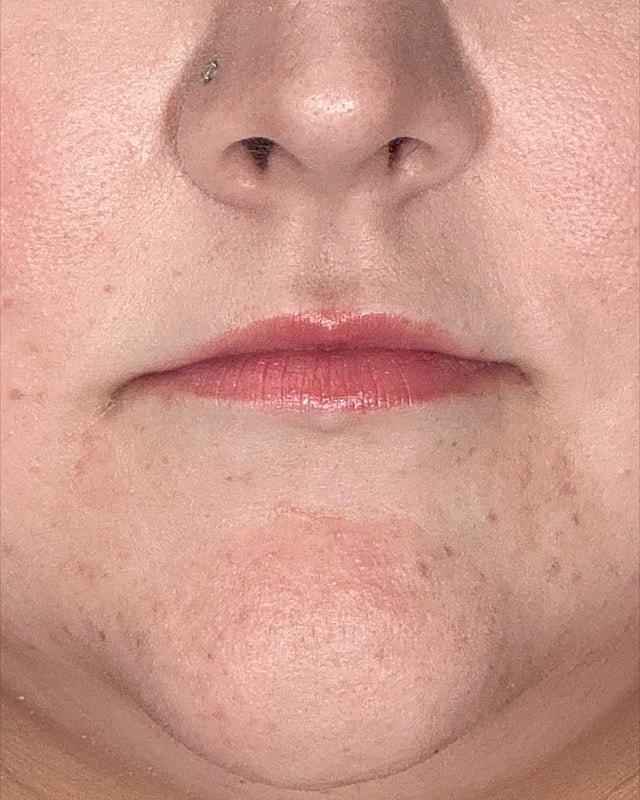 Juvederm Before & After