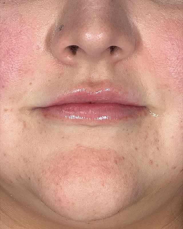 Juvederm Before & After