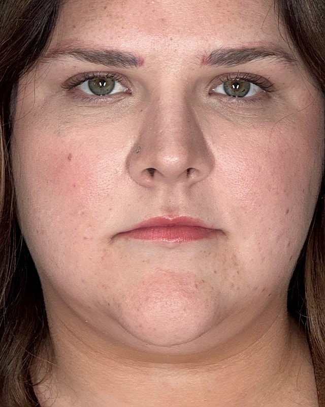 Juvederm Before & After