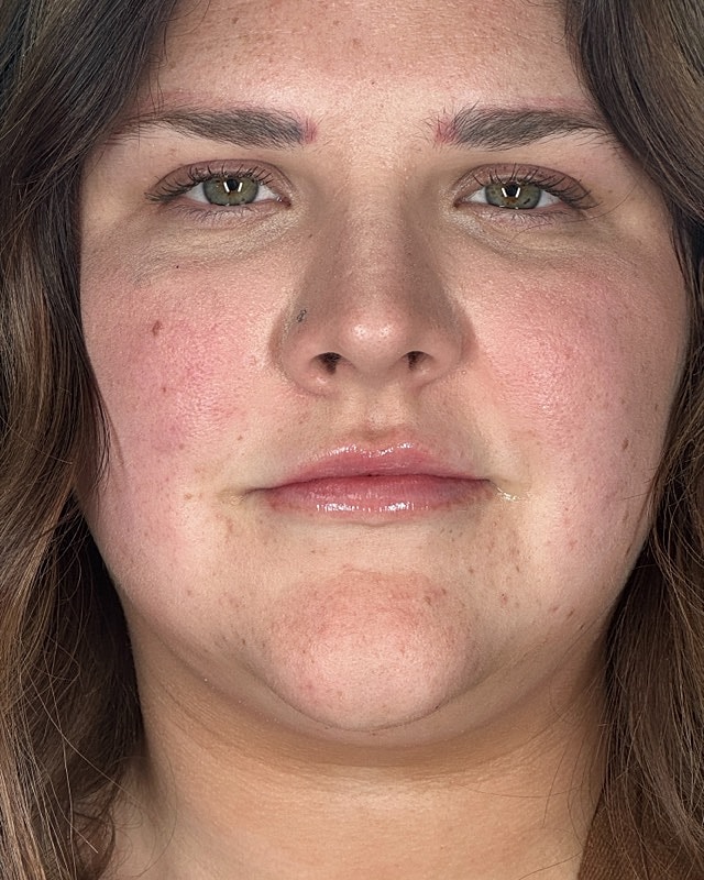 Juvederm Before & After