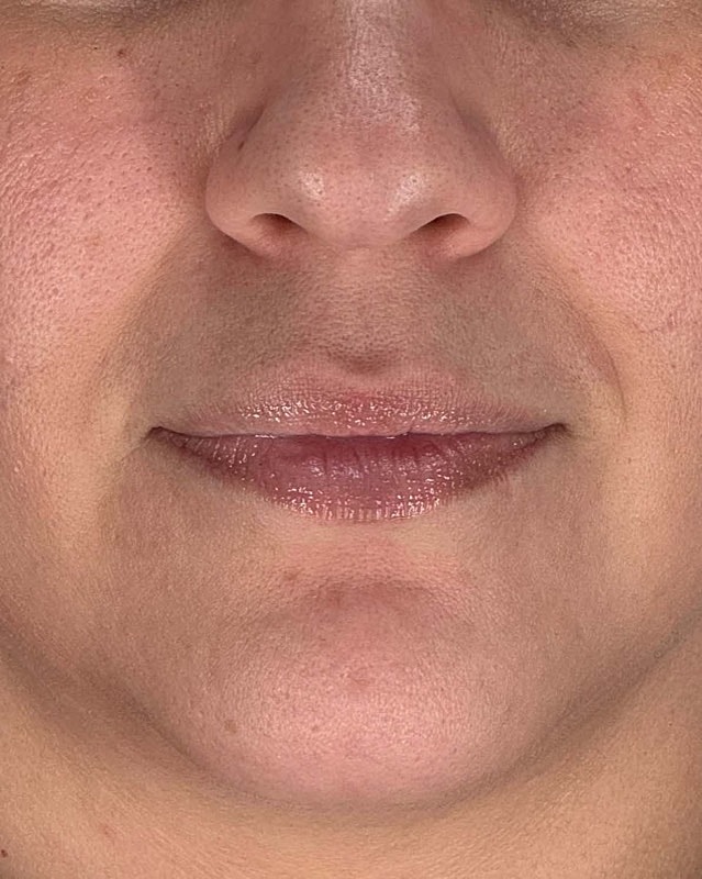 Juvederm Before & After