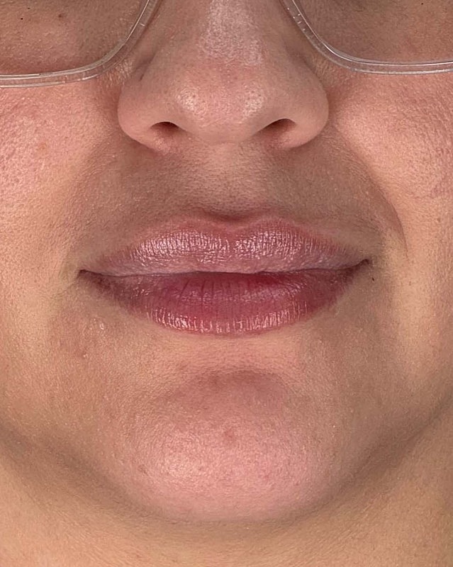 Juvederm Before & After