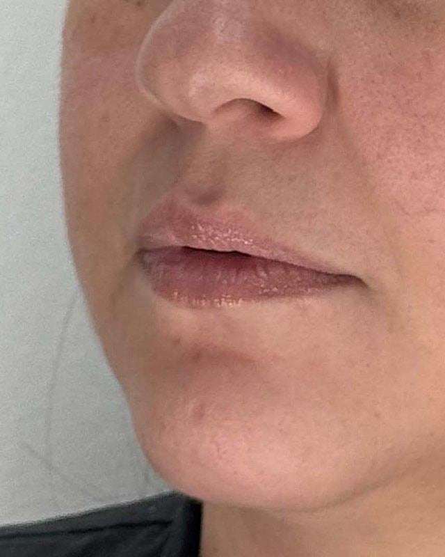 Juvederm Before & After