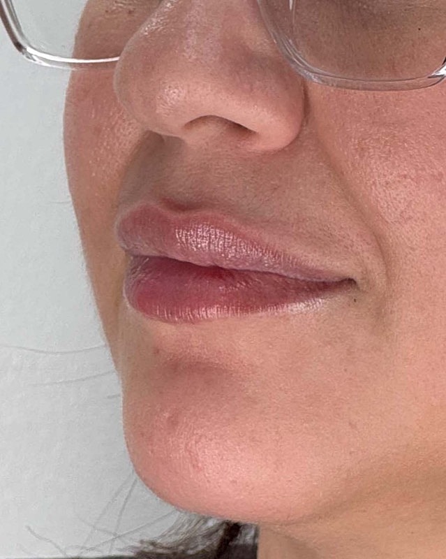 Juvederm Before & After