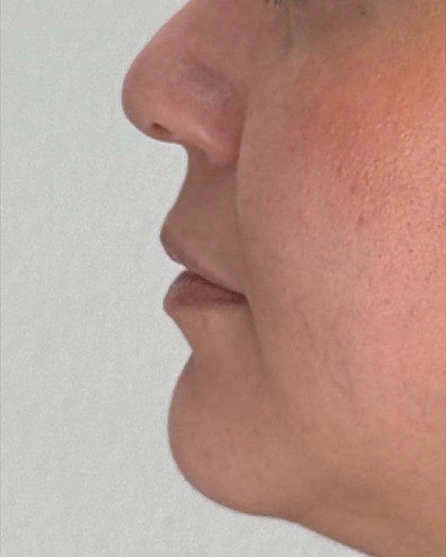 Juvederm Before & After