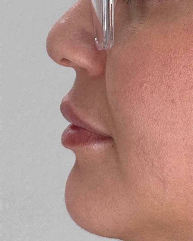 Juvederm Before & After