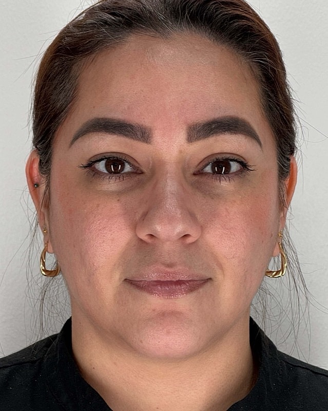 Juvederm Before & After