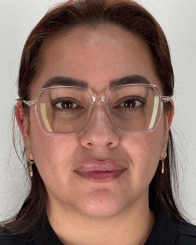 Juvederm Before & After