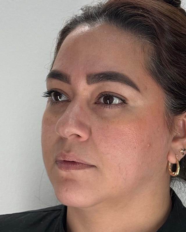Juvederm Before & After