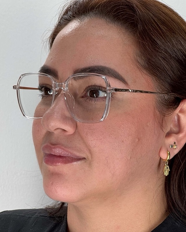 Juvederm Before & After