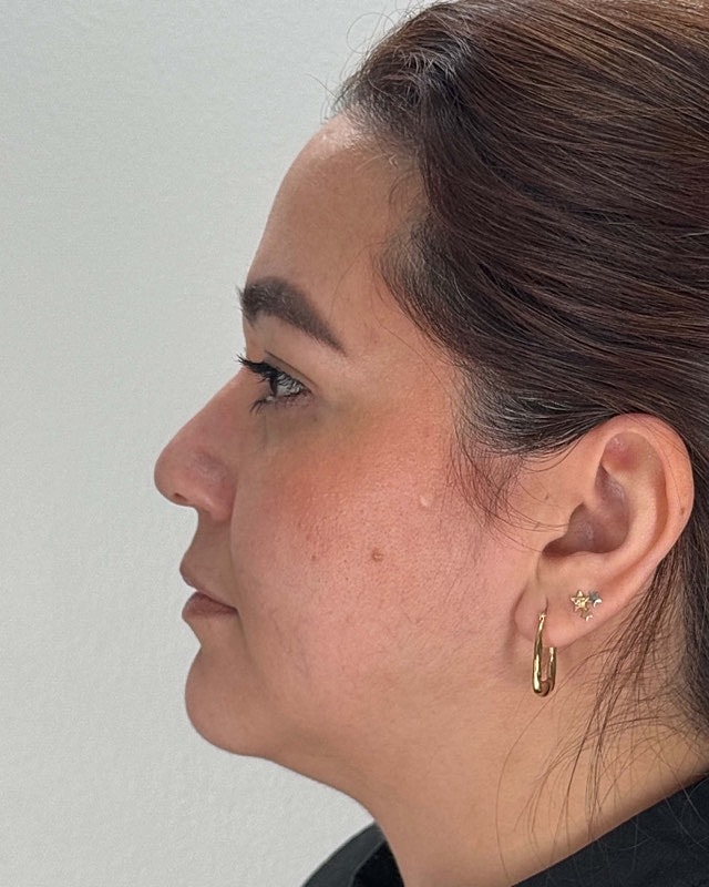 Juvederm Before & After