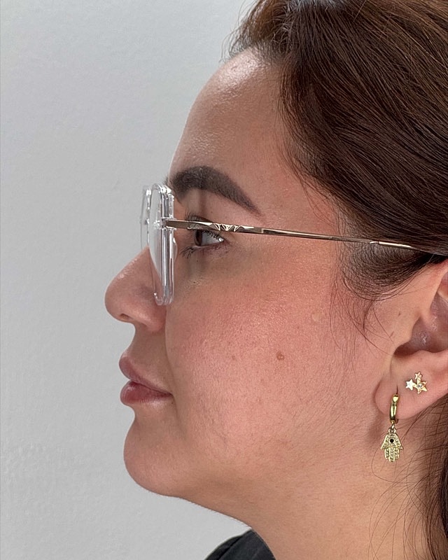 Juvederm Before & After