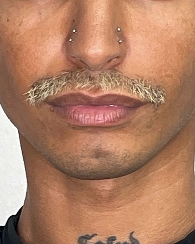 Juvederm Before & After