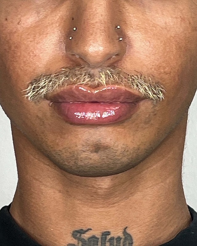 Juvederm Before & After