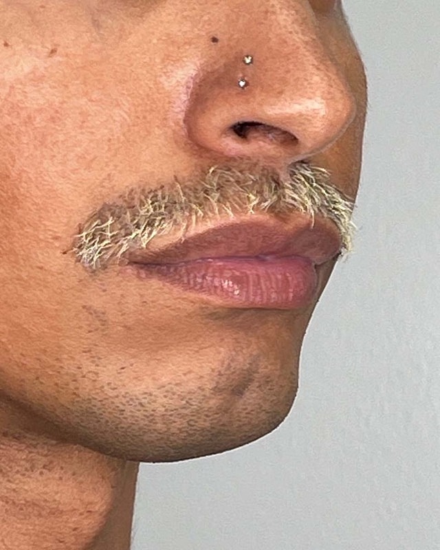 Juvederm Before & After