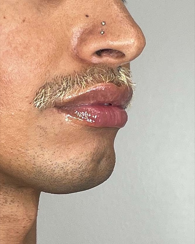 Juvederm Before & After