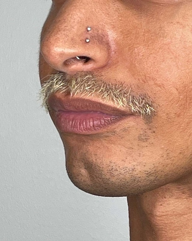Juvederm Before & After
